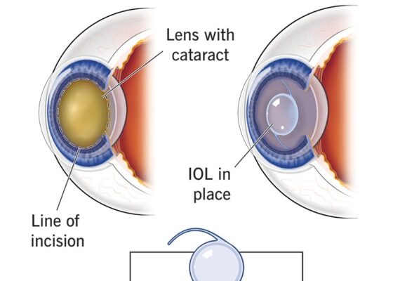 cataract-surgery