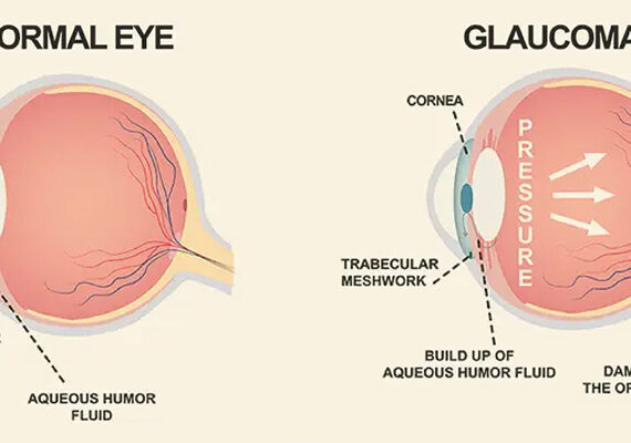 glaucoma-treatment-in-mumbai